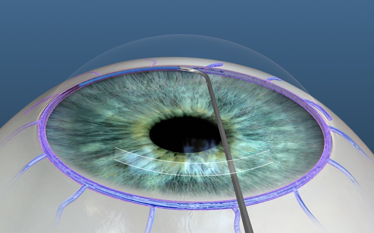 Glaucoma “ladrón silencioso de la visión” y formas de prevenirlo