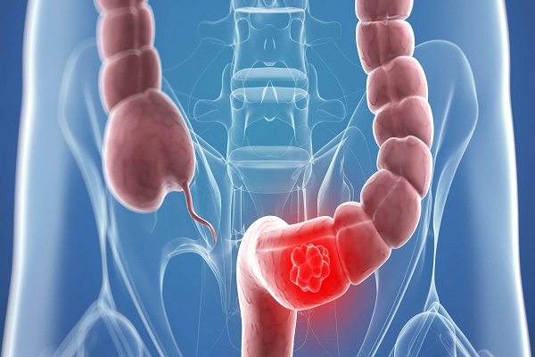 Científicos dan primer paso para mejorar detección temprana de cáncer colon