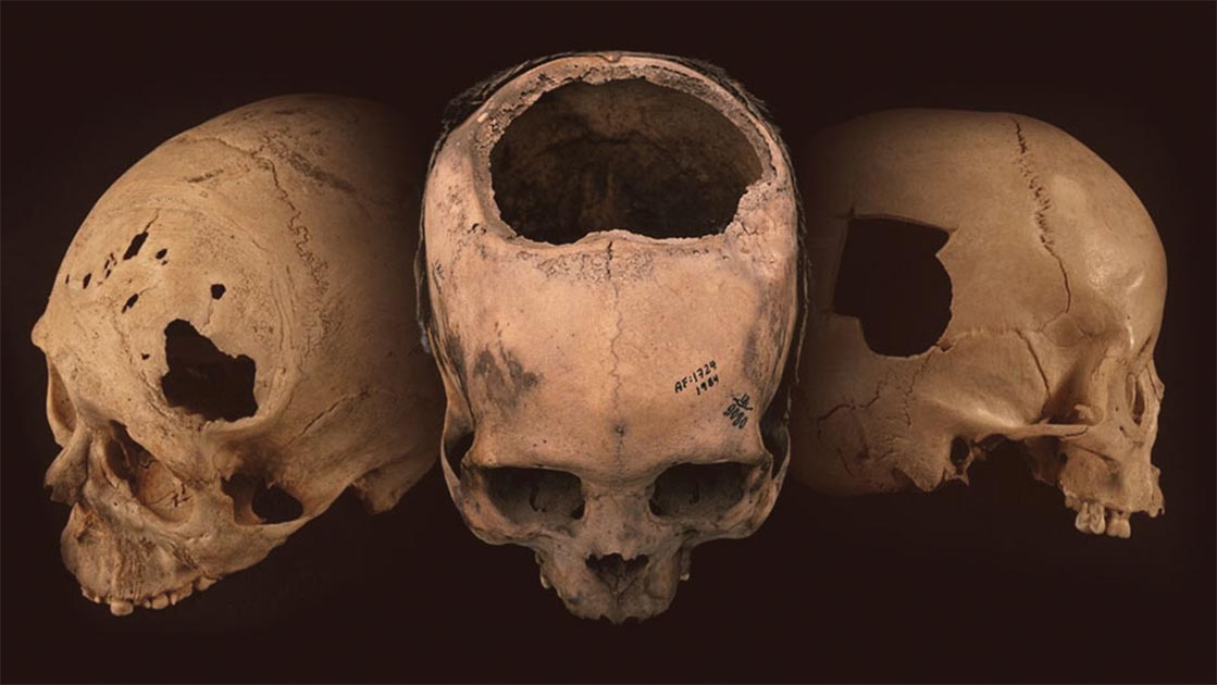 La trepanación más antigua en Oriente Próximo se remonta a la Edad de Bronce