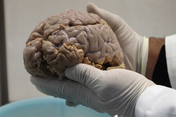 Desequilibrio del pH en el cerebro puede provocar alzhéimer