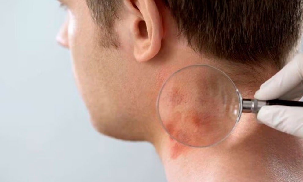 Identificada una mutación genética responsable de la psoriasis